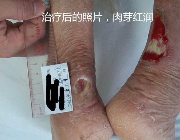 跟腱炎还能踢足球吗_跟腱断裂还能踢足球吗