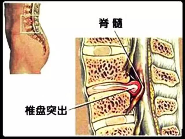 踢足球会引起腰间盘突出吗_踢足球会引起腰间盘突出吗视频