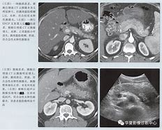 胰腺炎以后还能踢足球么_胰腺炎以后还能踢足球么嘛